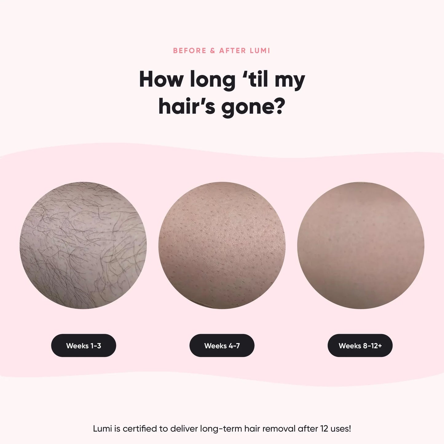 i3Smart™  Professional Laser Depilator