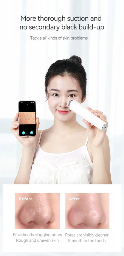 i3Smart™  Vacuum Acne Cleaner